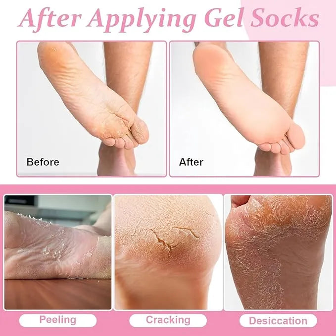 FRAKIN Silicone Moisturizing Socks for Cracked Feet